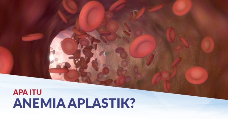 Waspada! Ini 7 Tanda-tanda Kamu Gejala Anemia Aplastik – Bungko News